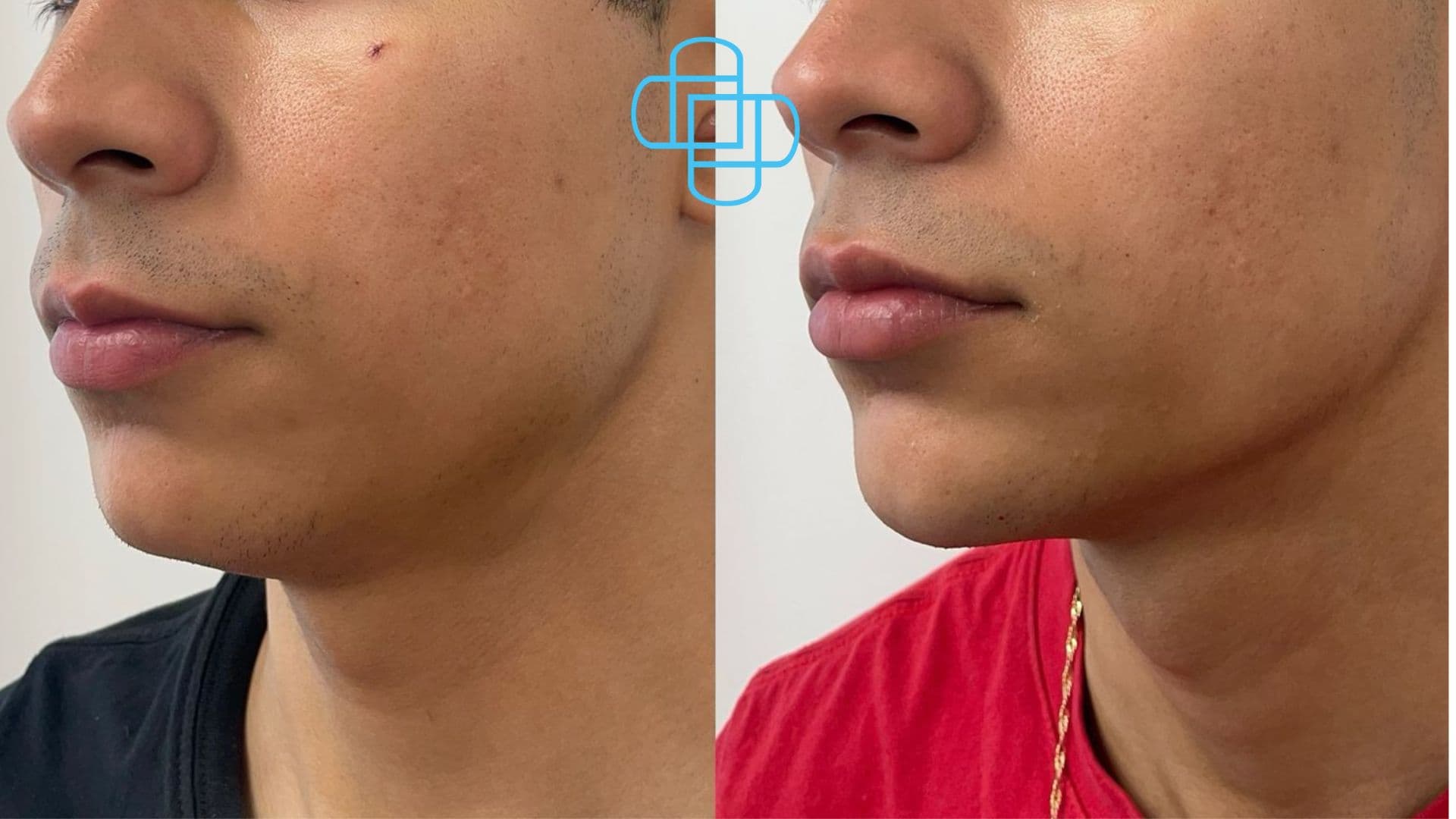 Antes y después: Ácido Hialurónico en Perfilado Mandibular