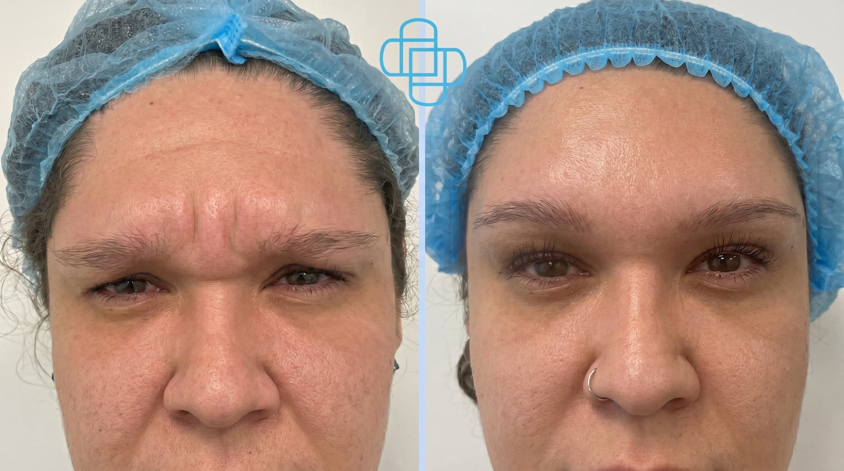 Antes y después: Toxina Botulínica en Entrecejo
