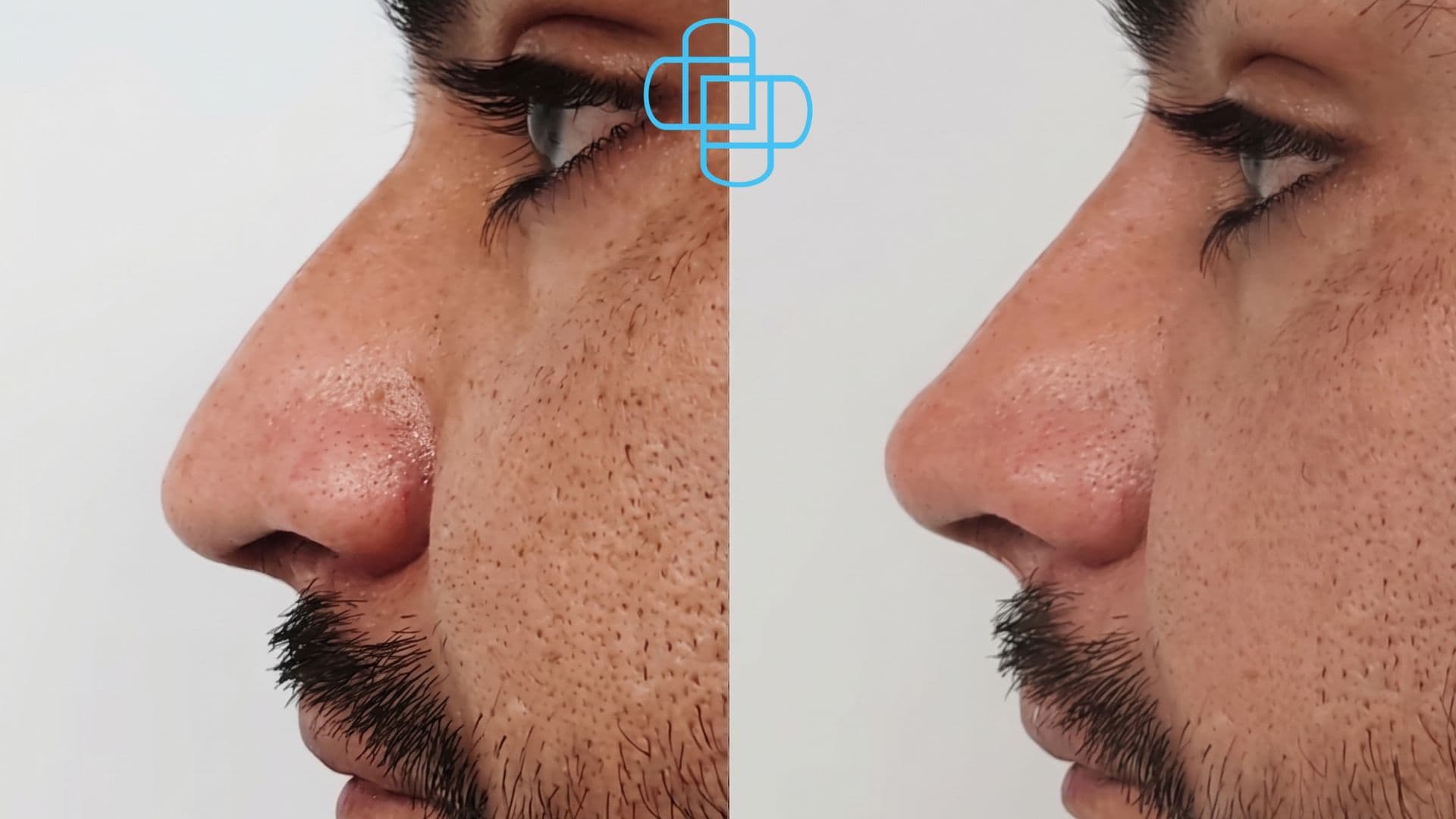 Antes y después: Rinomodelación con Acido Hialurónico