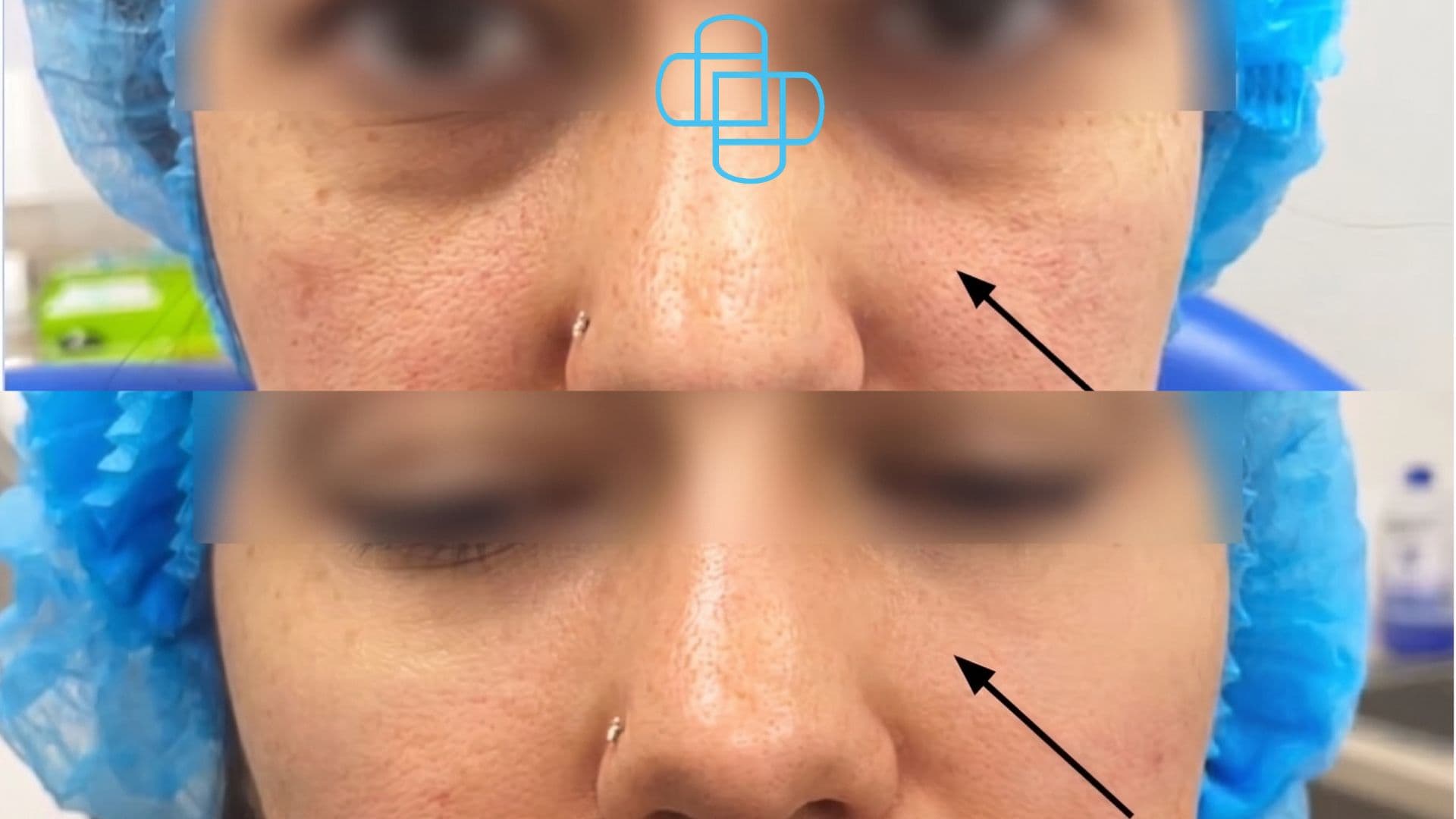 Antes y después: Ácido Hialurónico en Ojeras