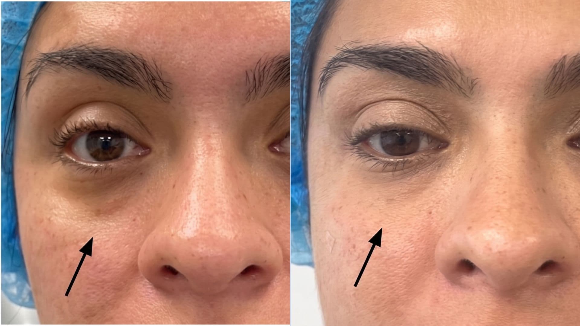 Antes y después: Ácido Hialurónico en Ojeras