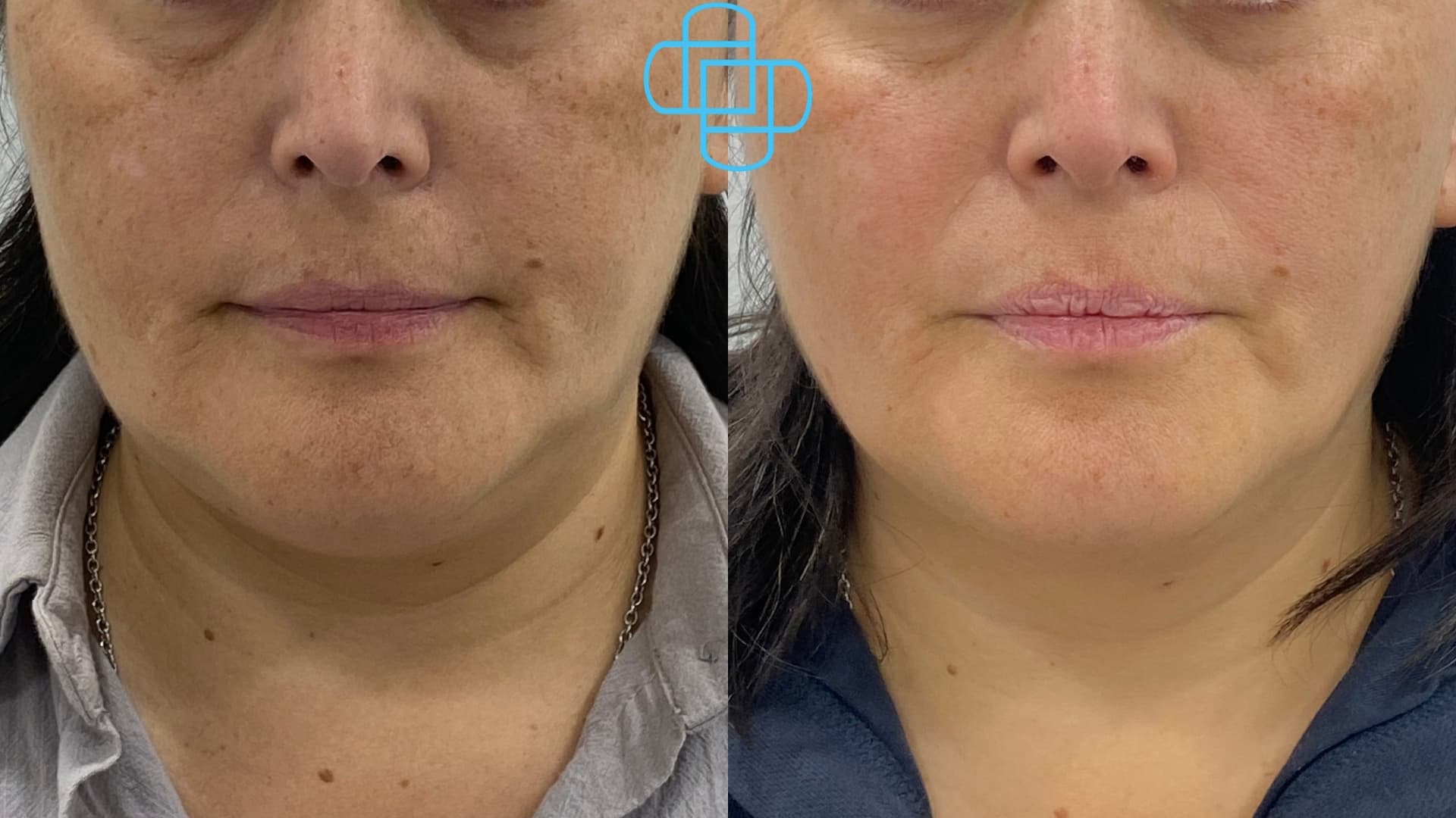 Antes y después: HIFU Liftera Medio Rostro Inferior + Cuello