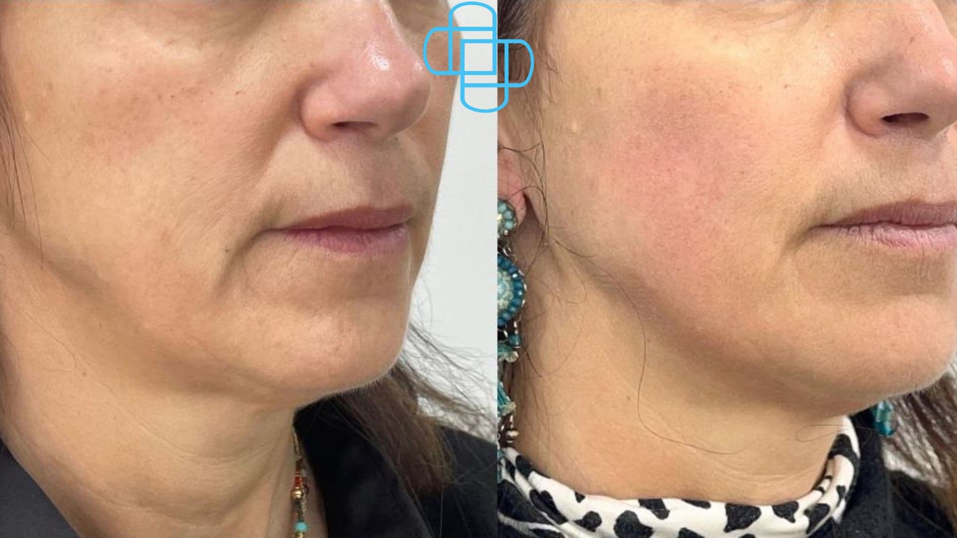 Antes y después: HIFU Liftera Rostro Completo