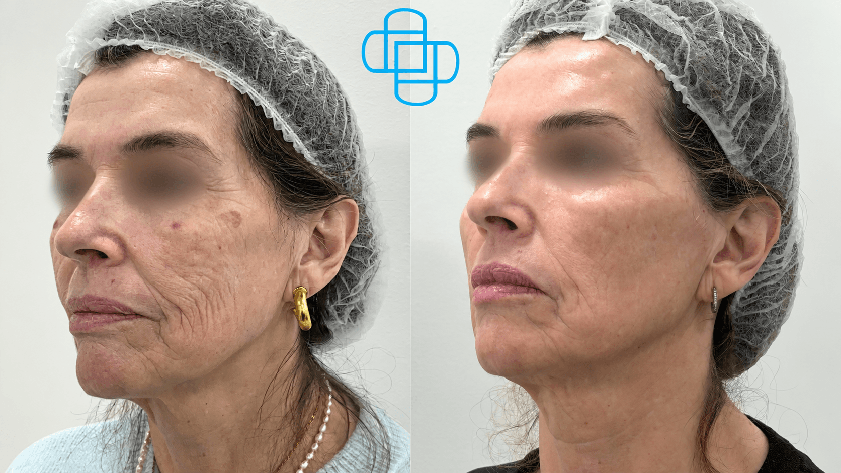 Antes y después: HIFU Liftera Rostro Completo y Cuello + Toxina Botulínica en Tercio Superior