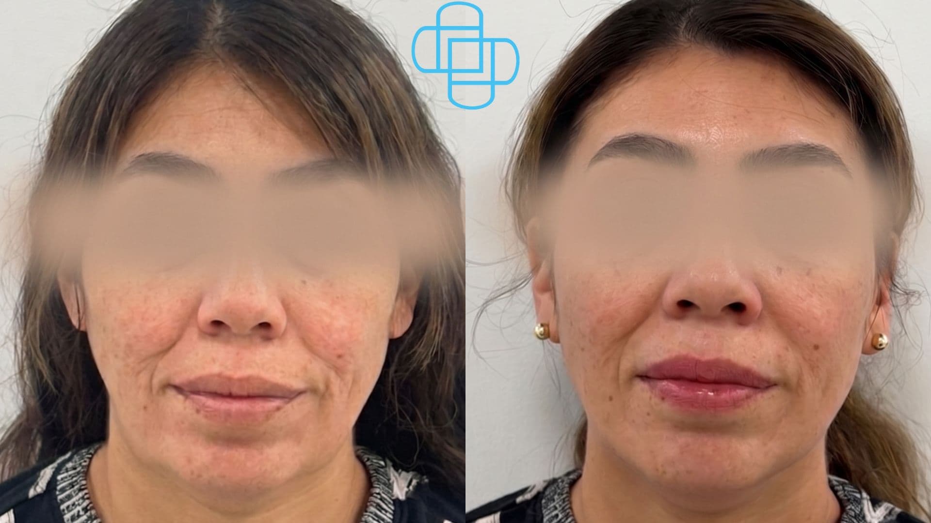 Antes y después: HIFU Liftera Tercio Inferior del Rostro