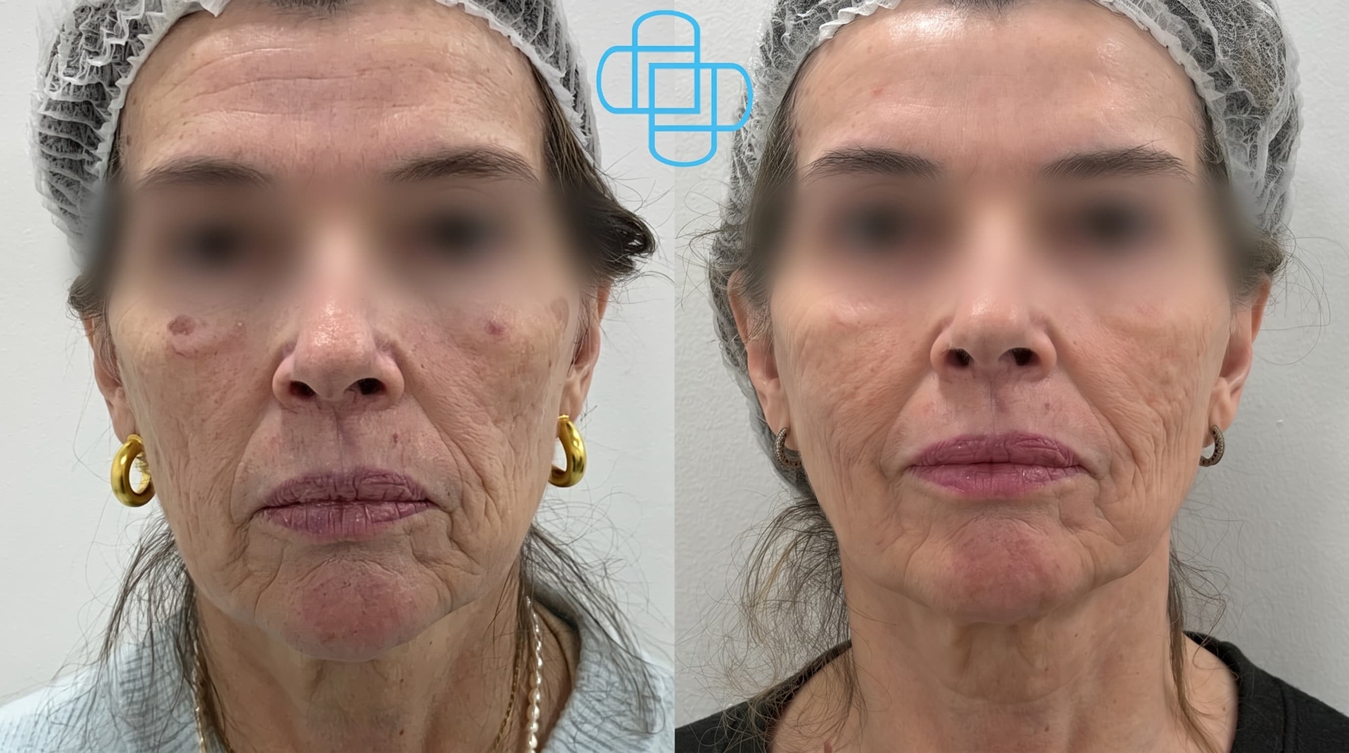 Antes y después: HIFU Liftera + Toxina Botulínica Tercio Superior