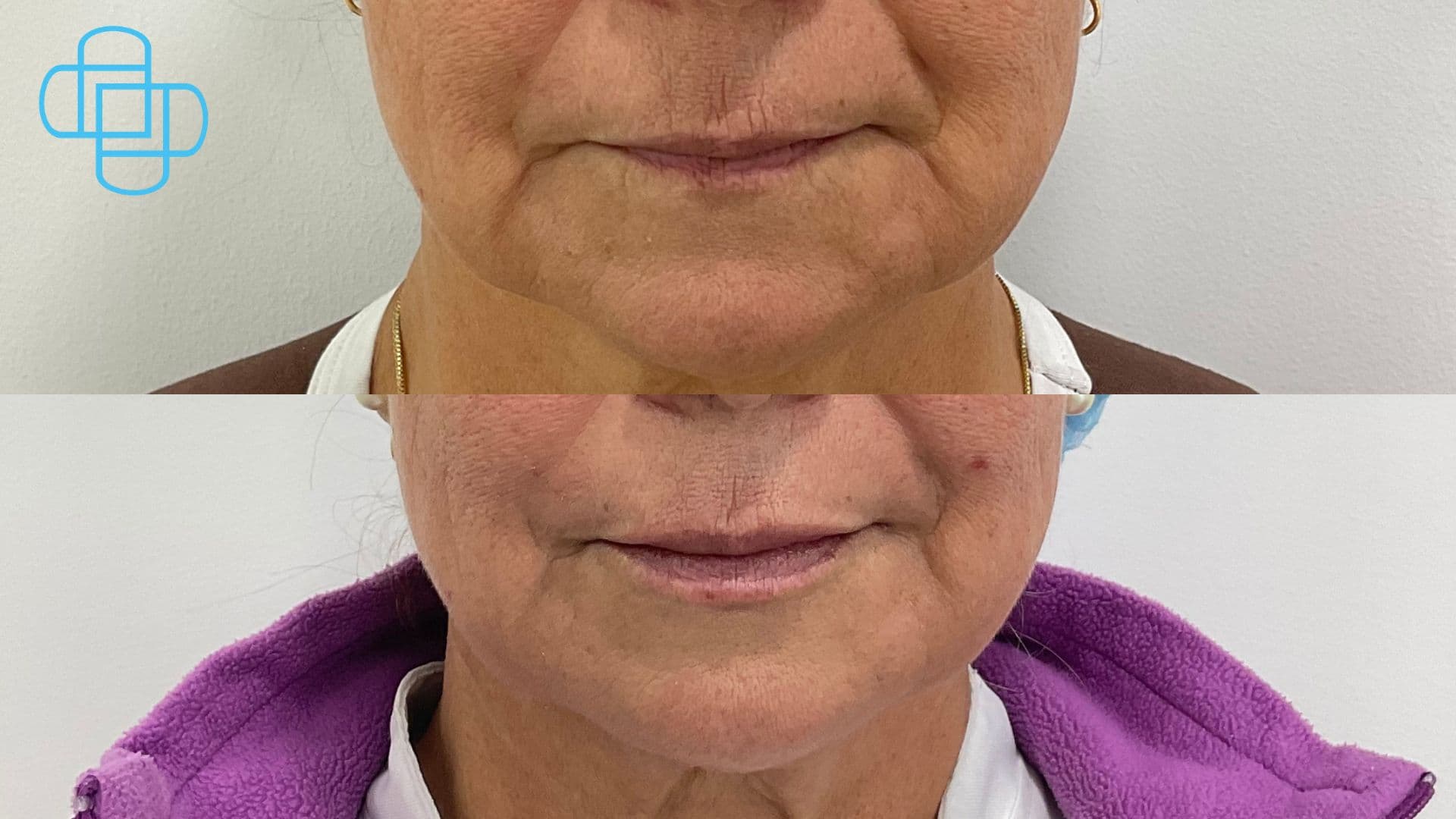 Antes y después: Perfilado e Hidratación de Labios