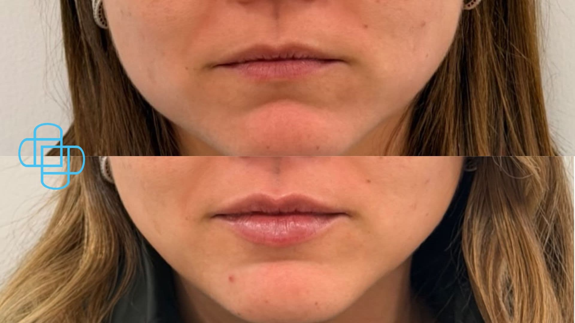 Antes y después: Relleno de Labios con Ácido Hialurónico