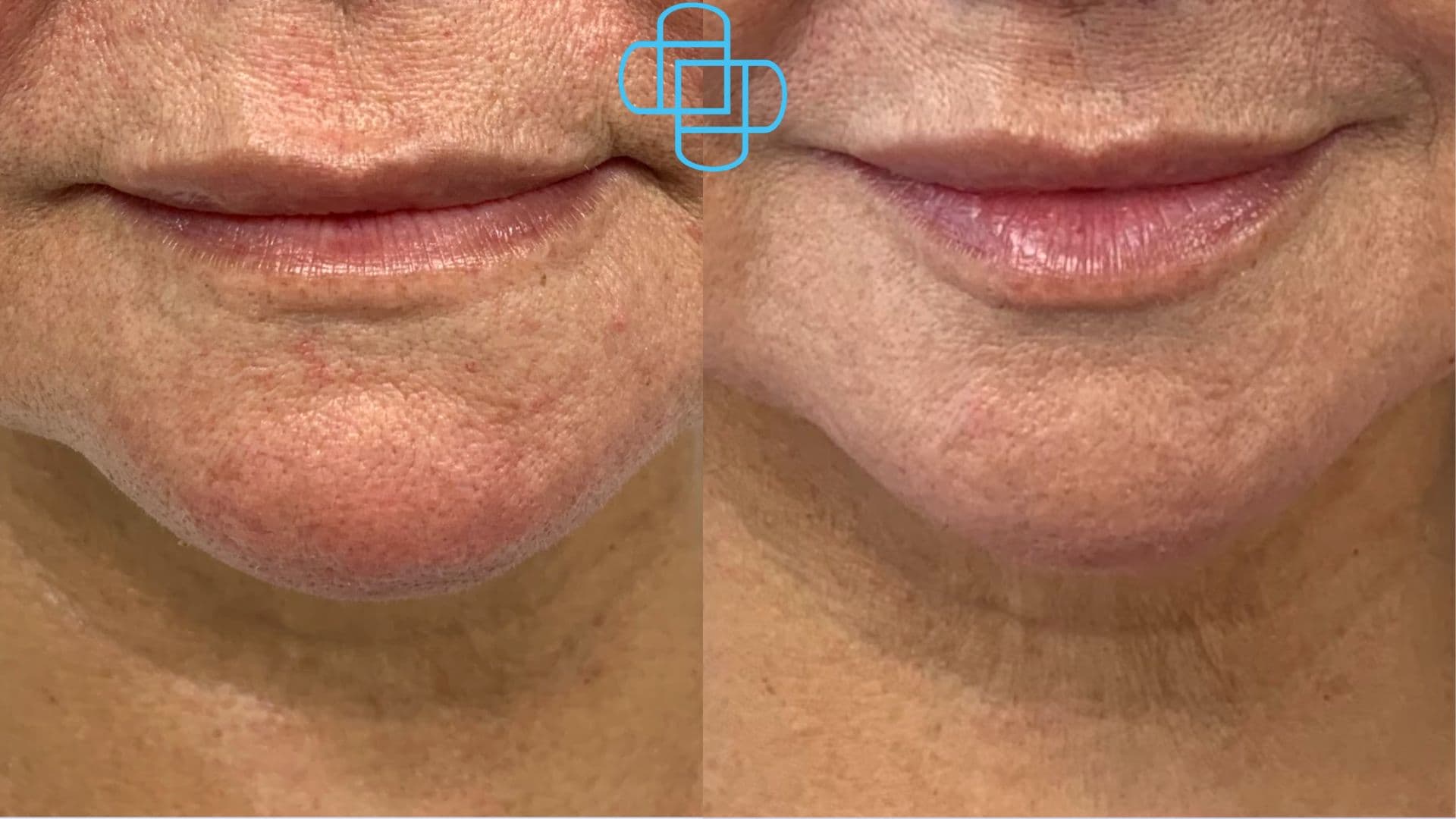 Antes y después: Relleno de Labios con Ácido Hialurónico