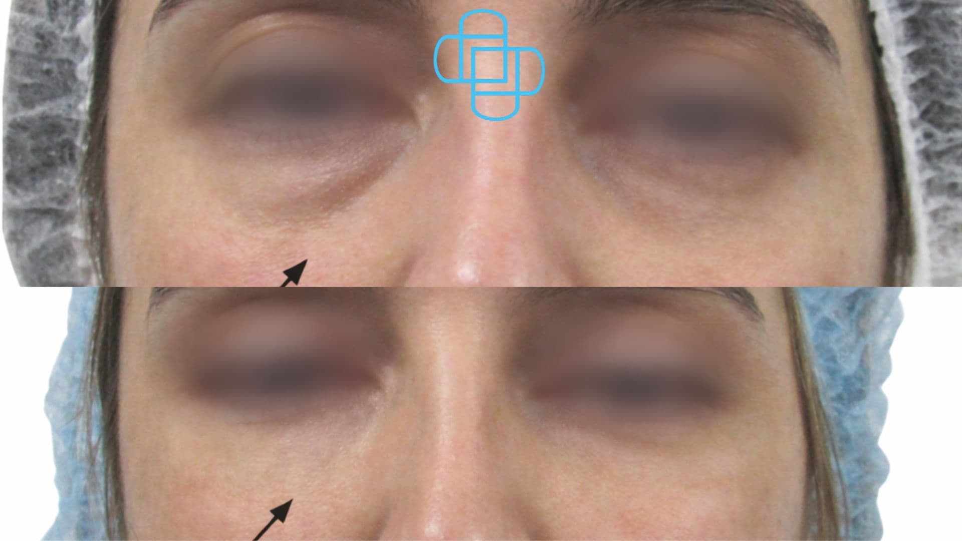 Antes y después: Relleno de Ojeras con Ácido Hialurónico