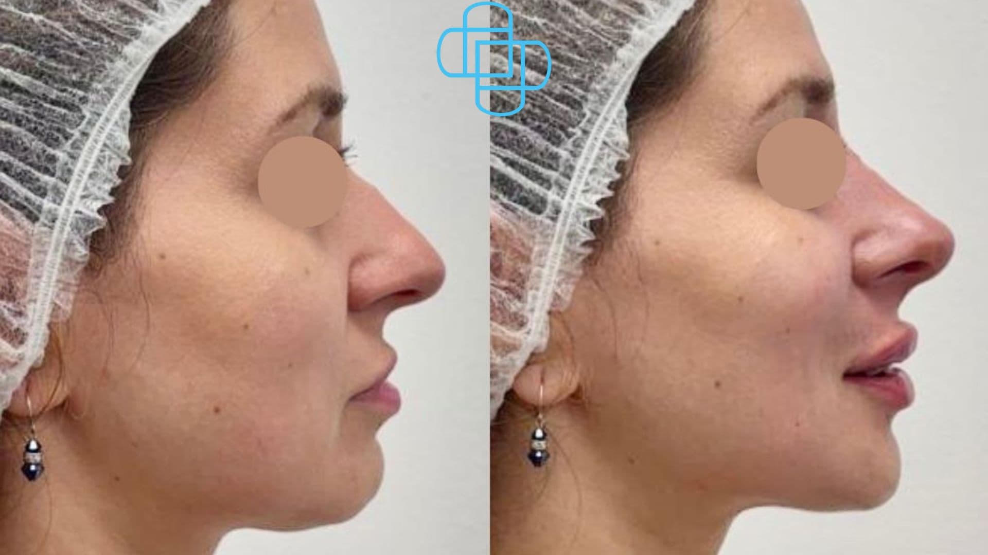 Antes y después: Rinomodelación más Relleno de Labios con Ácido Hialurónico