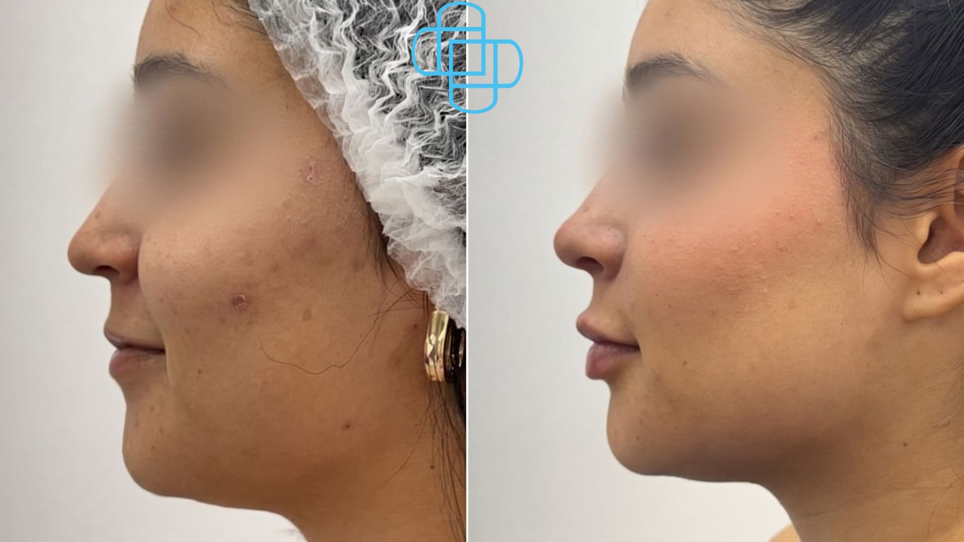 Antes y después: Rinomodelación y Relleno de Labios con Ácido Hialurónico
