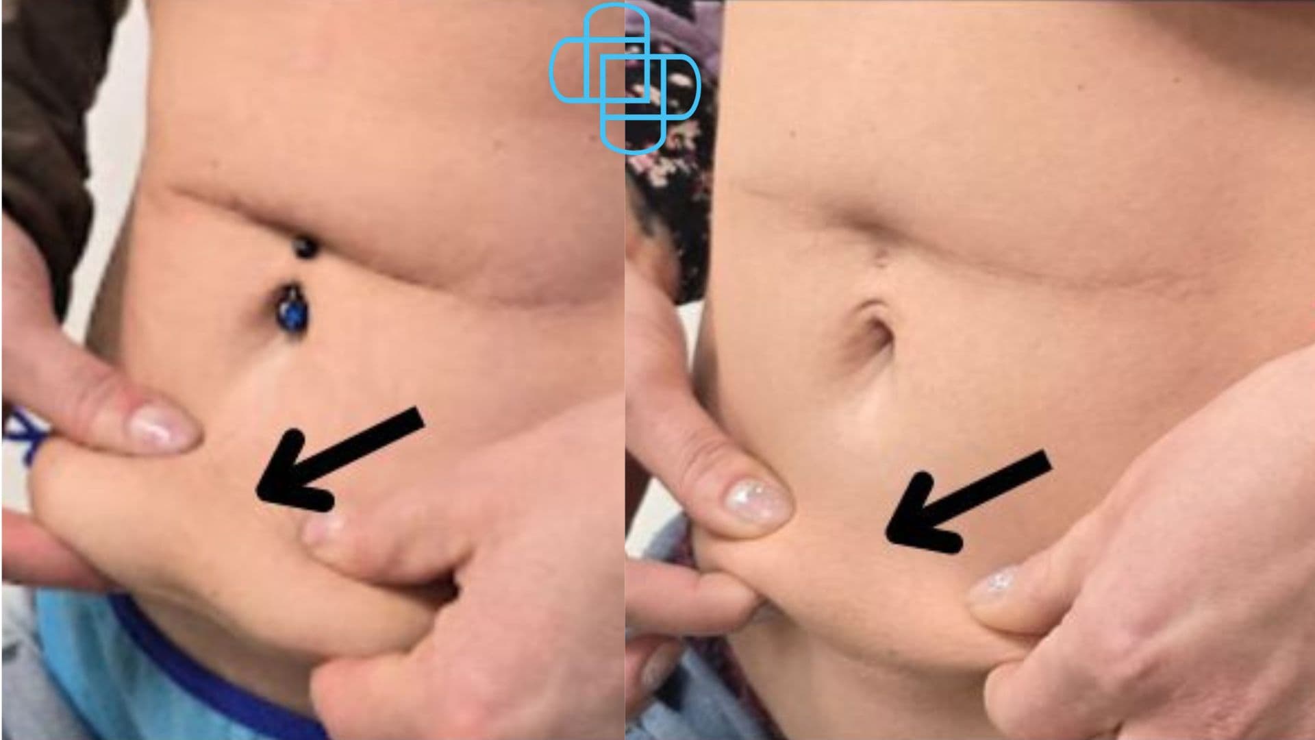 Antes y después: Sculptra Corporal Abdomen