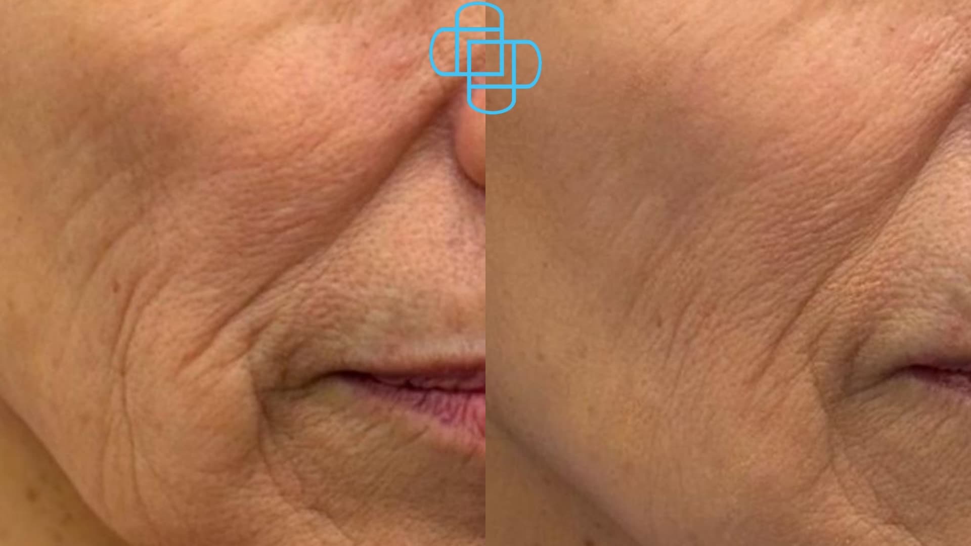 Antes y después: Sculptra disminuye arrugas finas y atenúa flacidez