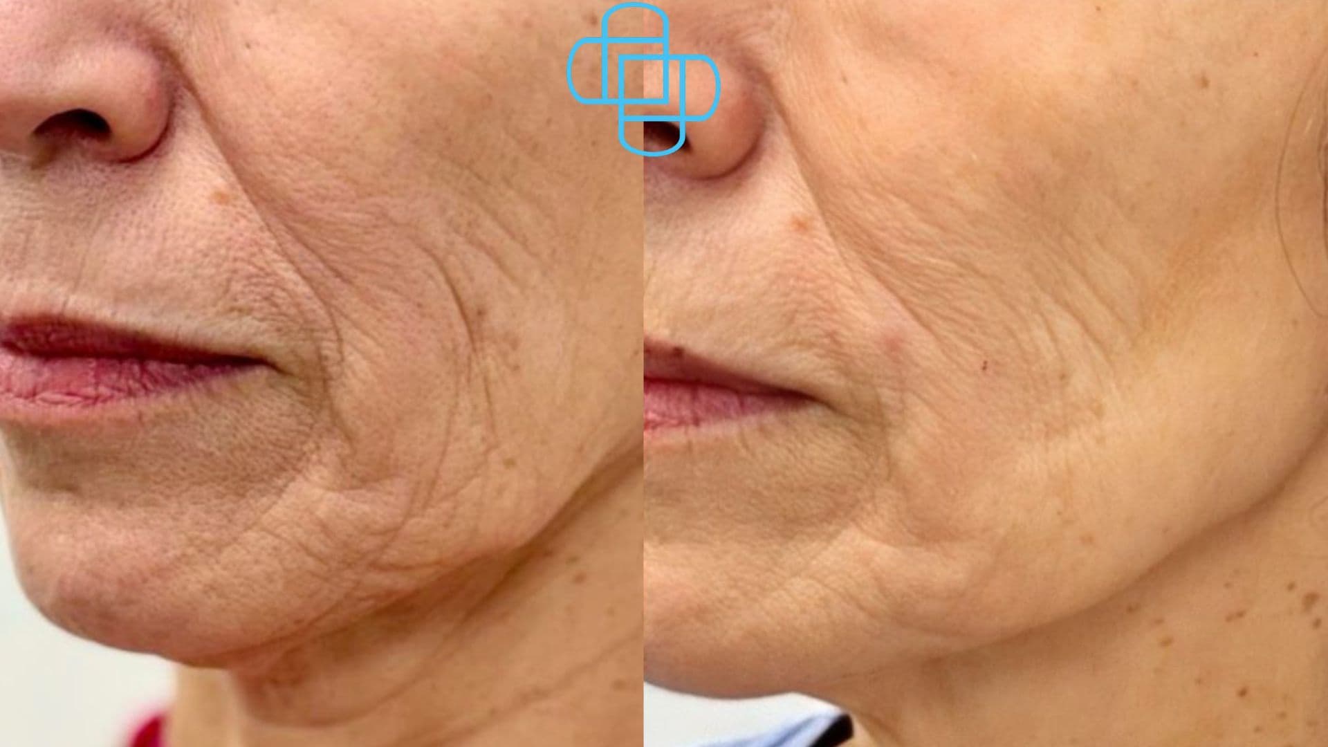 Antes y después: Sculptra en Rostro