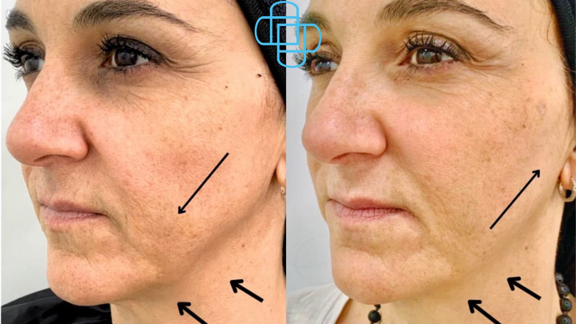 Antes y después: Sculptra - Renata Bravo