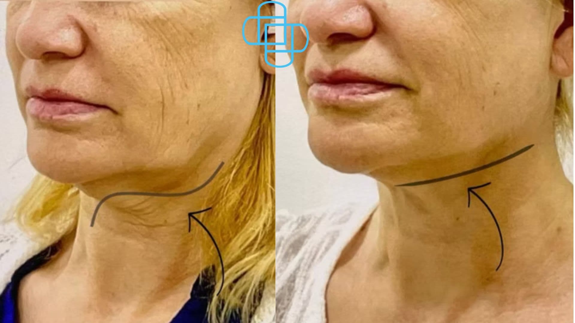 Antes y después: Sculptra Rostro Y Cuello