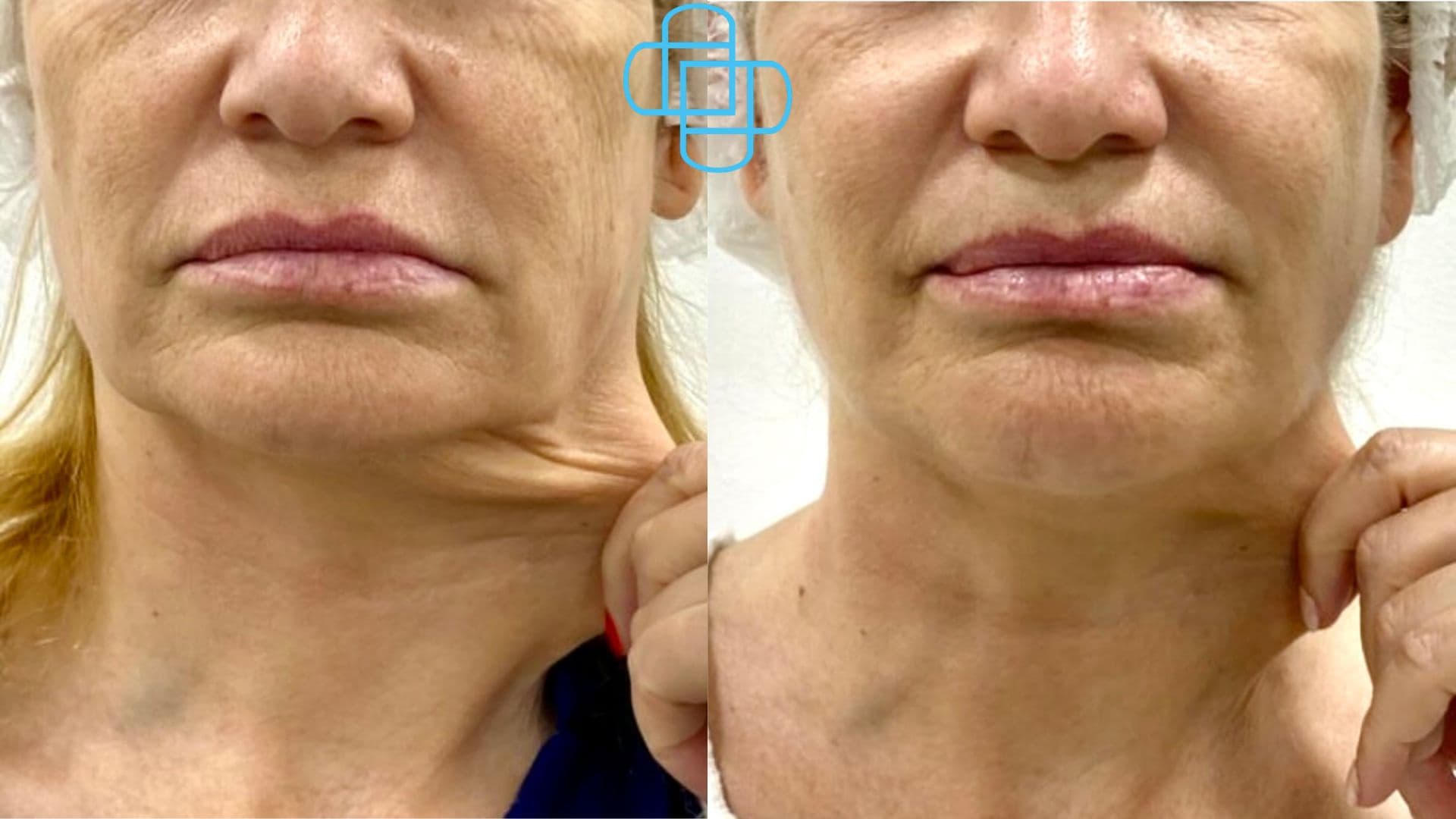 Antes y después: Sculptra Rostro y Cuello