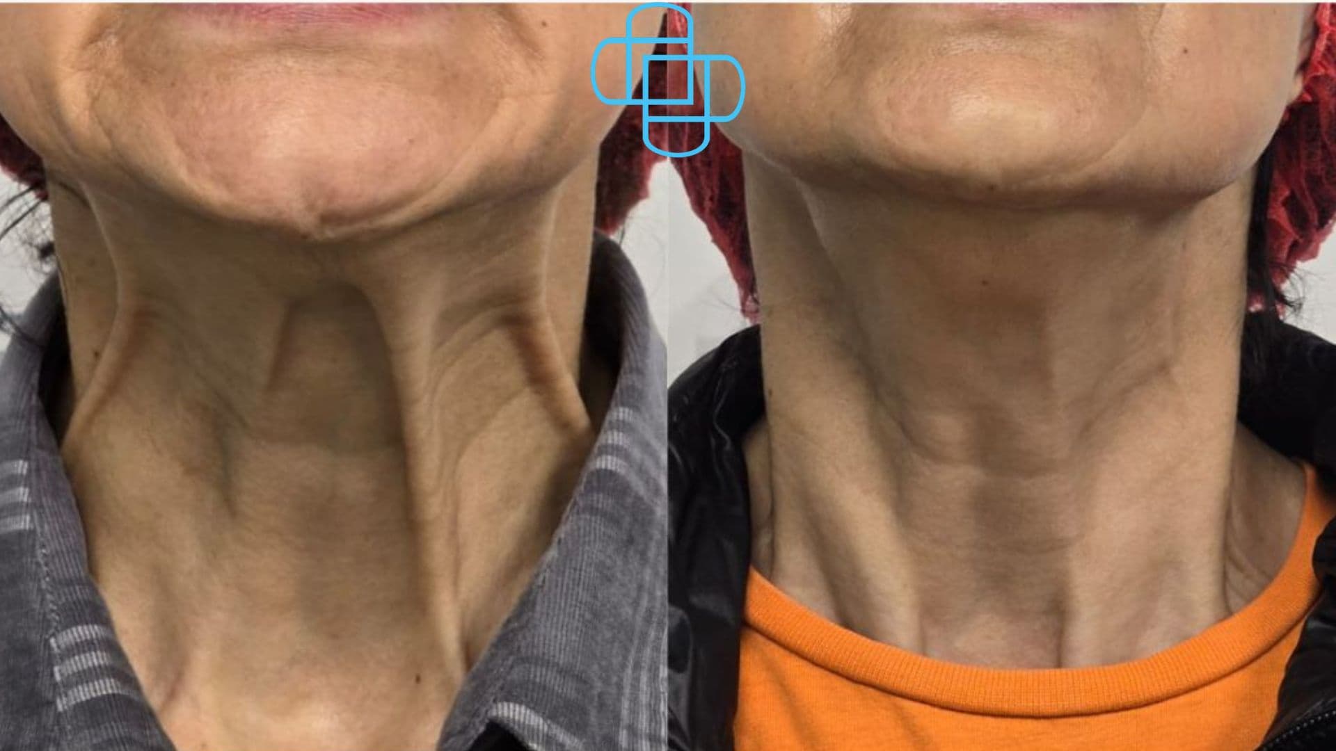 Antes y después: Toxina Botulínica en Bandas Platismales del Cuello