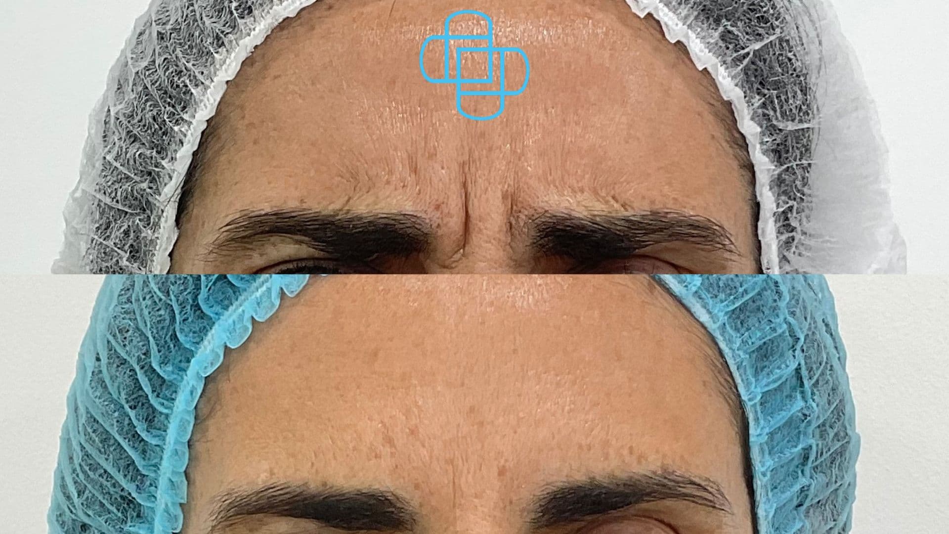 Antes y después: Toxina Botulínica en Entrecejo