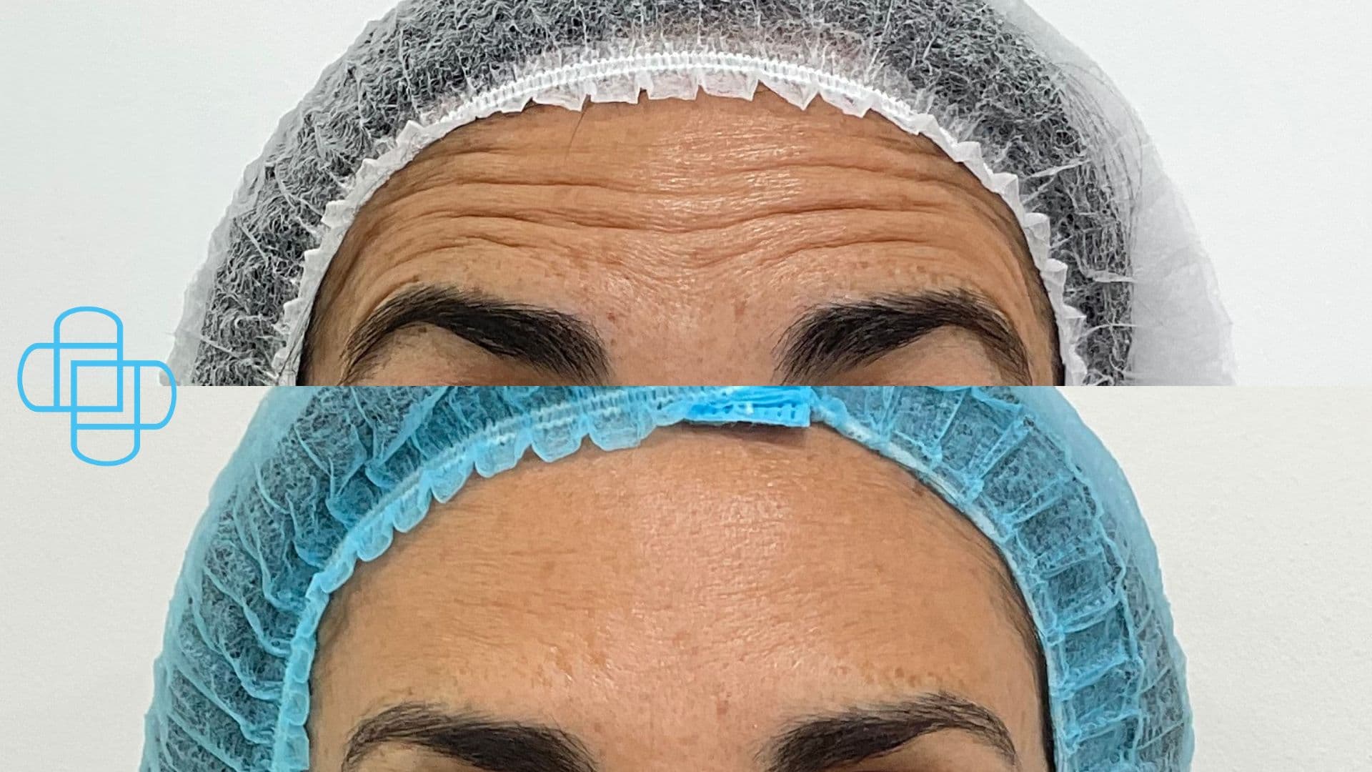 Antes y después: Toxina Botulínica en Frente