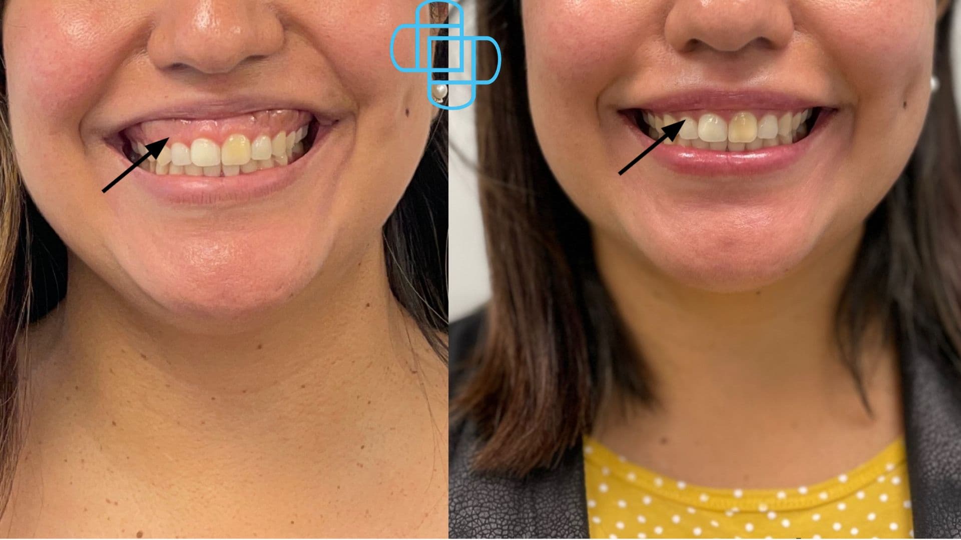 Antes y después: Toxina Botulínica para Sonrisa Gingival.